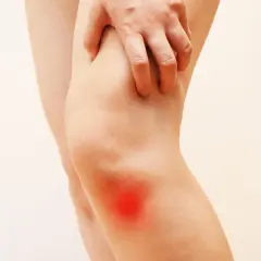 Dolore e bruciore al ginocchio interno, evidenziato da un'area rossa. La mano preme sulla zona dolente.