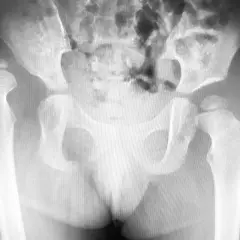 Radiografia del bacino e delle anche. Si nota una lussazione dell'anca, con implicazioni sui tempi di recupero.
