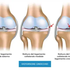Illustrazione di ginocchia con lesioni ai legamenti: rottura del legamento collaterale esterno, mediale e crociato anteriore.
