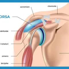 Illustrazione anatomica della spalla con etichette. Si vede la borsa, il deltoide, la cuffia dei rotatori, l'omero, il bicipite, l'acromion, la clavicola e la scapola.
