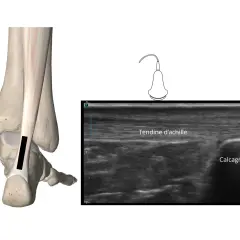 Ecografia del tendine d'Achille con evidenza di infiammazione. Anatomia e immagine ecografica.