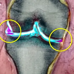 Risonanza magnetica del ginocchio evidenzia una lesione meniscale senza gonfiore, con aree di alterazione colorate in viola e blu.