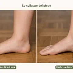 Confronto tra piede valgo di un bambino di 2 anni e di 10 anni, mostrando l'evoluzione della volta plantare.