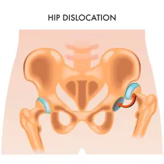 Illustrazione anatomica che mostra una lussazione dell'anca, con la testa del femore fuori dall'acetabolo.