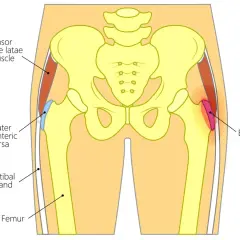 Illustrazione anatomica dell'anca che mostra la borsite trocanterica. Suggerimenti su come dormire con il dolore.
