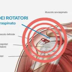 Illustrazione anatomica della spalla che evidenzia l'infiammazione della cuffia dei rotatori, in particolare del tendine sovraspinato.