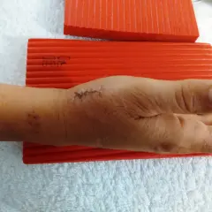 Mano con segni di sutura e taping per rizoartrosi pollice, appoggiata su asciugamano bianco con blocchi rossi.