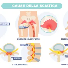 Illustrazione delle cause della sciatica: sindrome del piriforme, discopatia degenerativa, stenosi spinale ed ernia del disco, che provocano dolore al nervo sciatico.