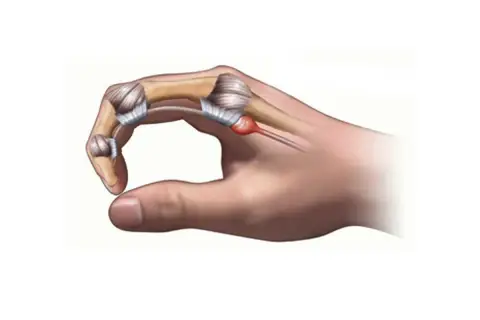 Dito cosa fare per il pollice a scatto: infiammazione del tendine e della guaina tendinea.