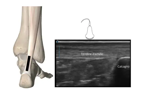 Ecografia del tendine d'Achille con evidenza di infiammazione. Anatomia e immagine ecografica.