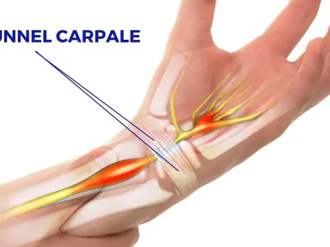 Chirurgia del tunnel carpale - quando serve e come recuperare