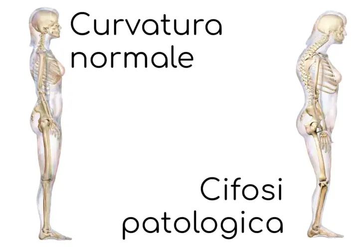 Scheletri a confronto: uno con curvatura normale, l'altro con cifosi patologica, evidenziando la curvatura lombare alterata.