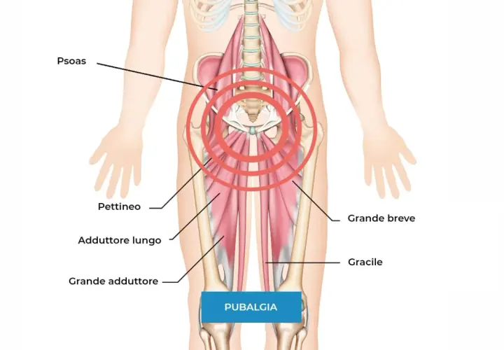 Anatomia della pubalgia: focus su psoas, pettineo, adduttori e gracile. Scopri come curare la pubalgia velocemente con esercizi mirati.