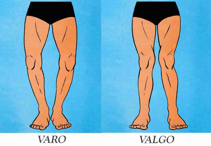 Gambe con valgismo (ginocchia a X) e varismo (ginocchia arcuate). Confronto visivo tra le due condizioni.