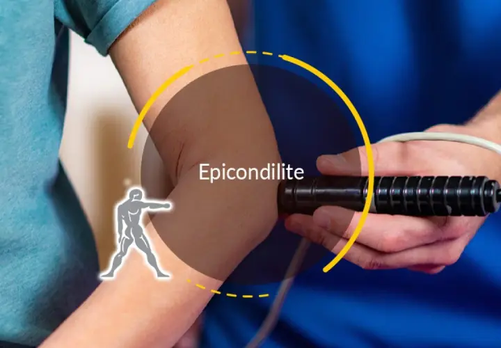 Trattamento per epicondilite: un dispositivo medico applicato al gomito per alleviare il dolore.