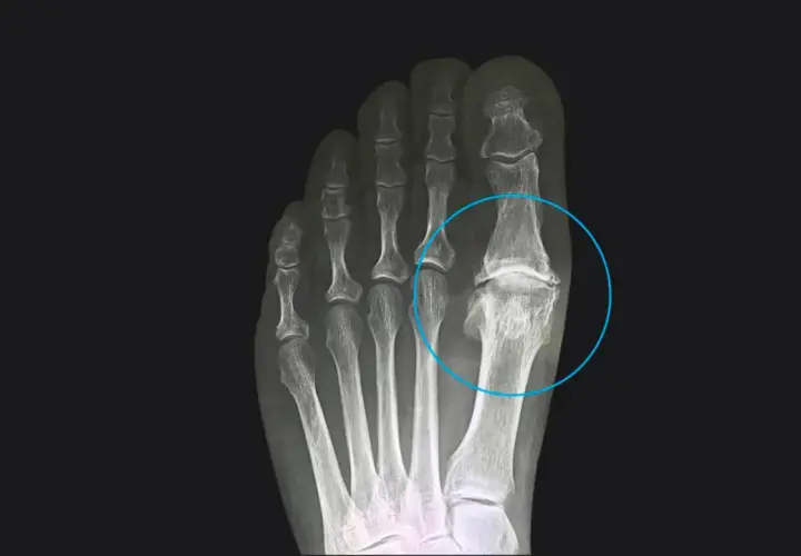 Radiografia del piede che evidenzia l'alluce rigido, con deformità e fusione ossea nell'articolazione metatarso-falangea.