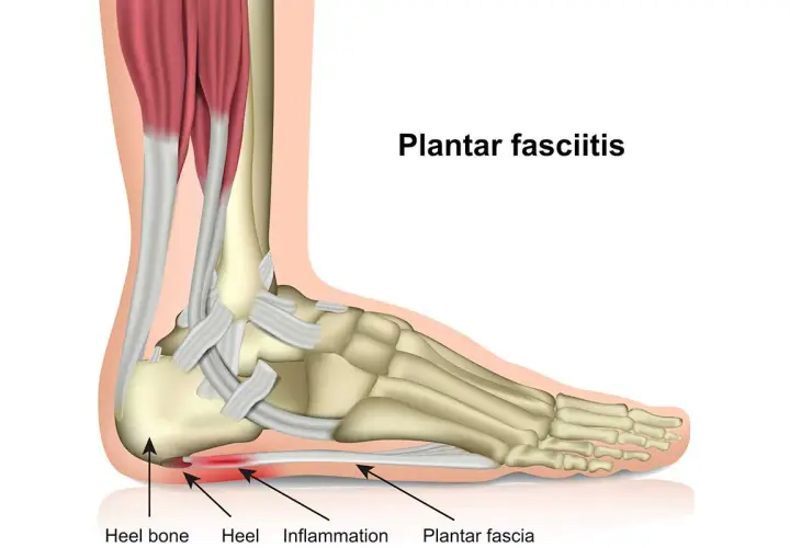 Anatomia del piede con fascite plantare, infiammazione del tallone. Il magnesio può aiutare.