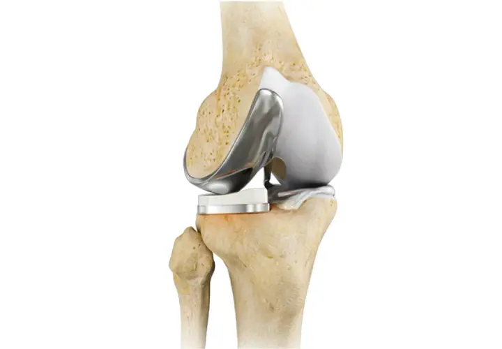 Protesi al ginocchio: un'immagine anatomica che mostra la sostituzione articolare. Quanto dura il dolore dopo la protesi al ginocchio?