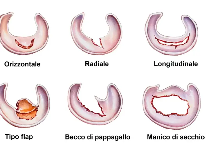 Illustrazioni di vari tipi di menisco rotto: orizzontale, radiale, longitudinale, a lembo, a becco di pappagallo e a manico di secchio.