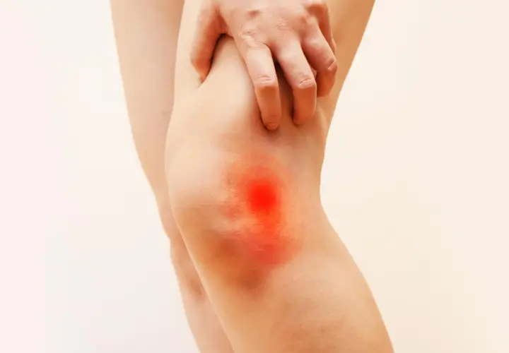 Dolore al ginocchio esterno, con un'area rossa e infiammata che indica una scossa.