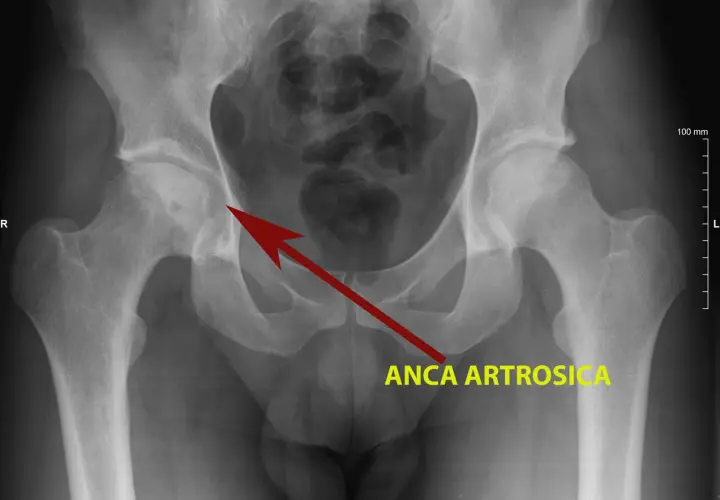 Radiografia del bacino che mostra un'anca artrosica, con freccia rossa che indica l'area interessata.