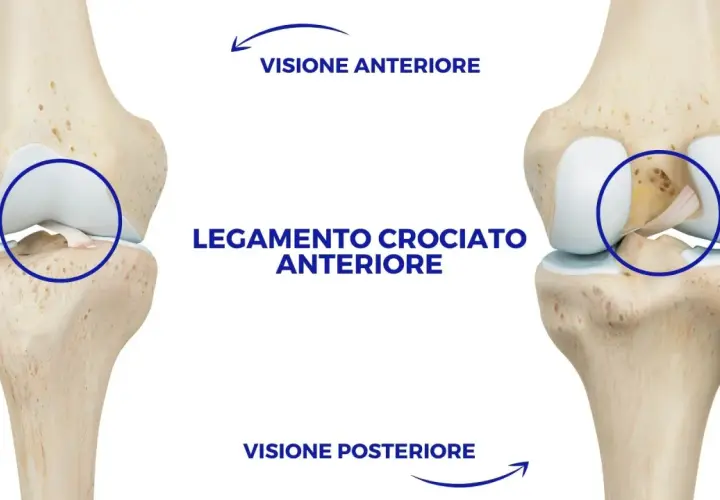 Legamento crociato anteriore rotto in visione anteriore e posteriore del ginocchio.