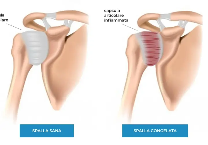Spalla sana vs spalla congelata: la capsula articolare infiammata mostra i sintomi di dolore e rigidità.