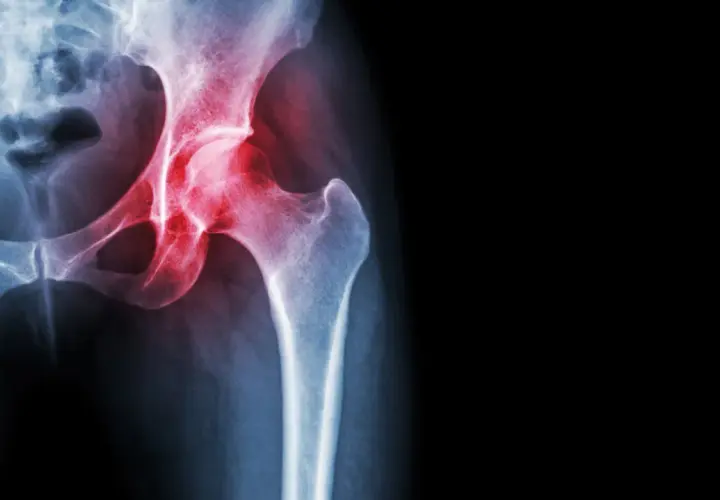 Radiografia del bacino con evidenza di trocanterite. Camminare fa bene per migliorare la mobilità dell'anca.
