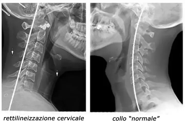 Radiografie cervicali: a sinistra, rettilineizzazione del rachide cervicale con frecce che indicano possibili conseguenze; a destra, collo "normale".