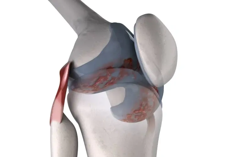 Dettaglio anatomico di un ginocchio con cartilagine danneggiata, che suggerisce ginocchia che scricchiolano.