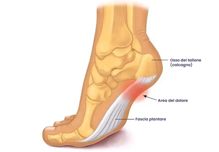 Illustrazione anatomica del piede che mostra il dolore al tallone come spilli, con la fascia plantare infiammata e l'osso del tallone.