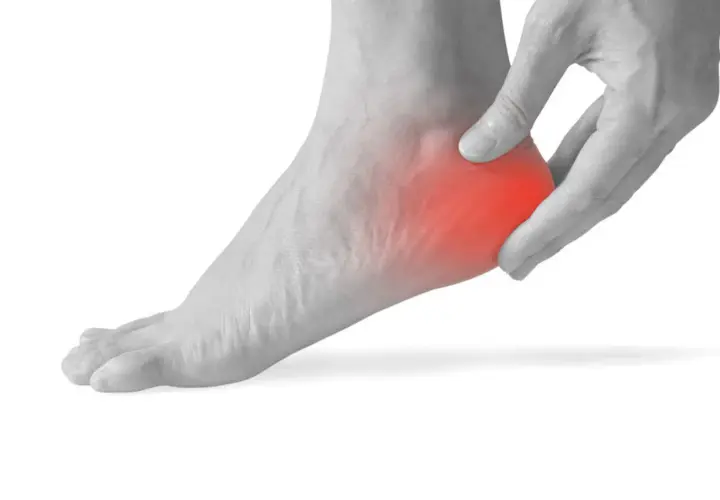 Piede con dolore al tallone, evidenziato in rosso. Utile per illustrare spina calcaneare esercizi.