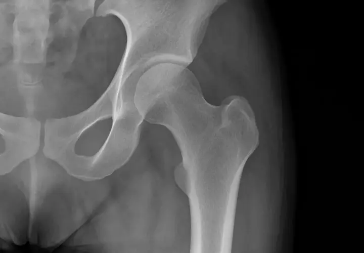 Radiografia dell'anca che mostra una calcificazione ossea.
