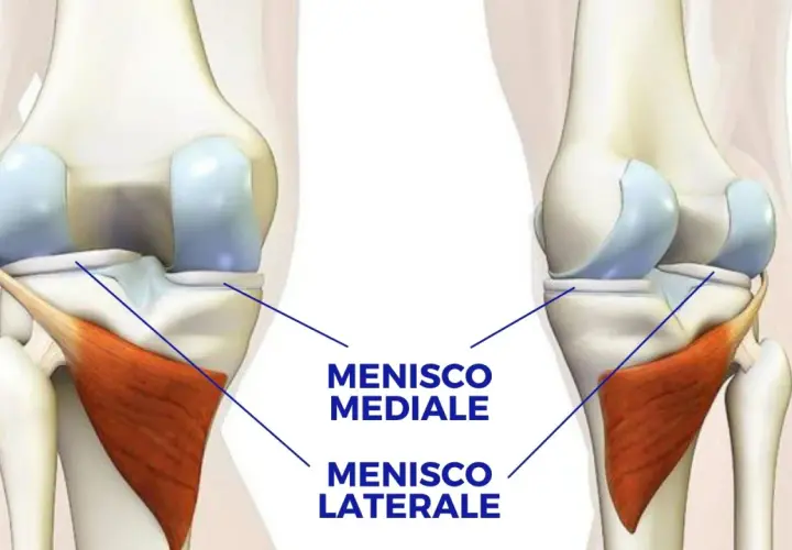 Illustrazione anatomica del ginocchio che evidenzia il menisco mediale e il menisco laterale, strutture cartilaginee essenziali per la stabilità e il movimento.