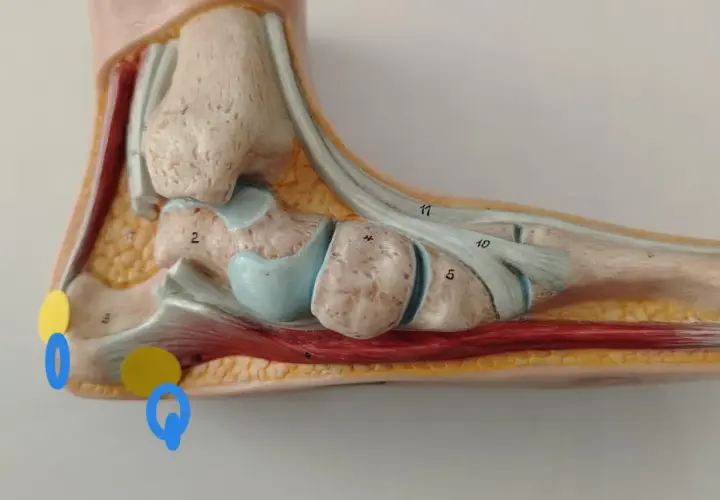 Modello anatomico del piede evidenzia la spina calcaneare trascurata, con aree di interesse cerchiate in giallo e blu.