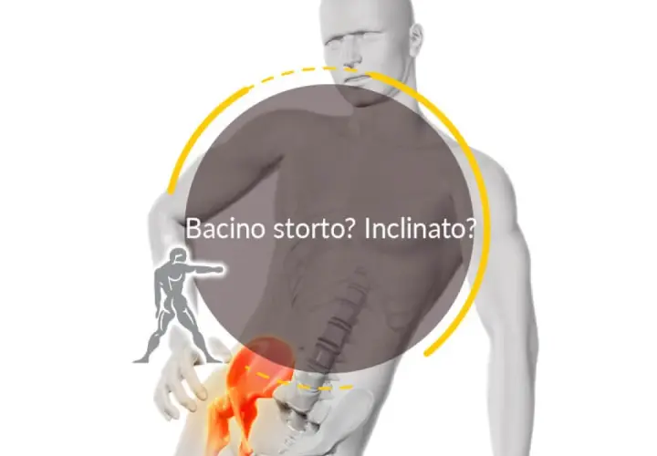 Un bacino ruotato può causare problemi neurologici. L'immagine mostra un modello anatomico con un bacino inclinato, evidenziato in rosso, e la scritta "Bacino storto? Inclinato?".