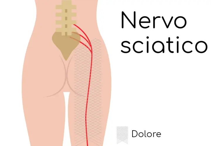 Illustrazione anatomica del nervo sciatico e del lombo cruralgia. Il dolore si irradia lungo la gamba.