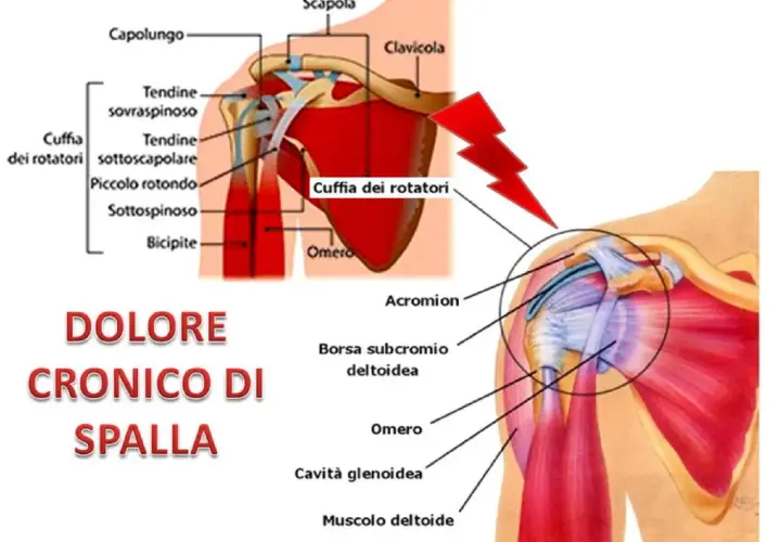 Dolore cronico di spalla destra quando alzo il braccio, con illustrazioni anatomiche della cuffia dei rotatori e dei muscoli della spalla.
