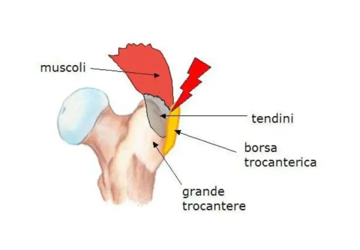 Diagramma anatomico dell'anca che mostra il grande trocantere, i muscoli, i tendini e la borsa trocanterica, evidenziando un'area di potenziale infiammazione.