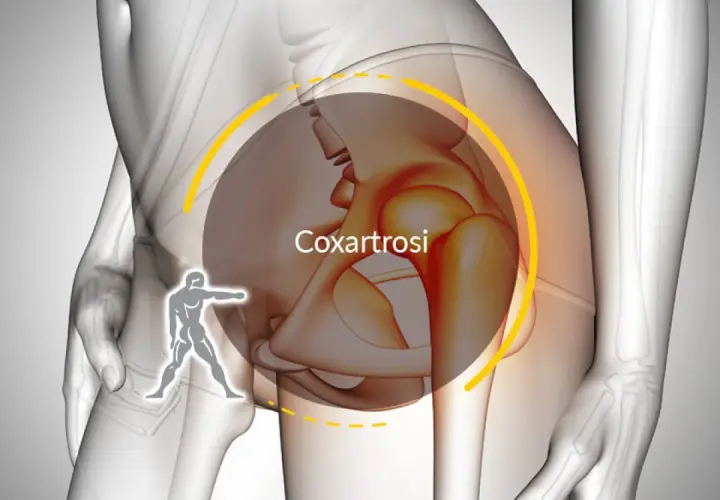 Illustrazione anatomica che evidenzia la coxartrosi, causa di dolore all'anca. I sintomi possono variare.