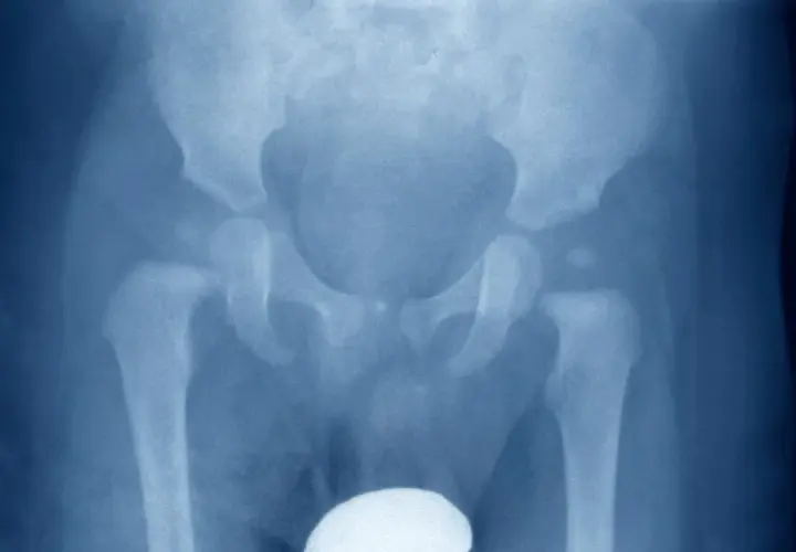 Radiografia del bacino e delle anche, evidenzia un'osteocondrosi dell'anca, con alterazioni della testa del femore.