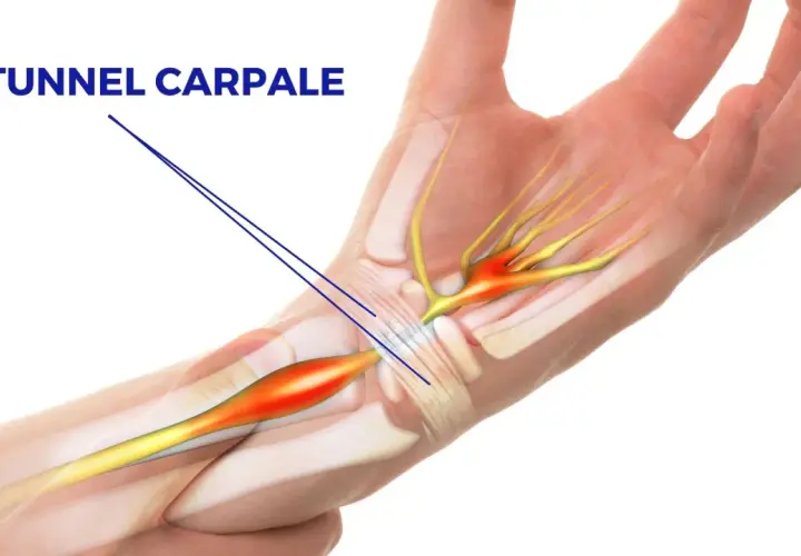 Illustrazione anatomica del tunnel carpale con evidenziata la compressione del nervo, che può richiedere un intervento.