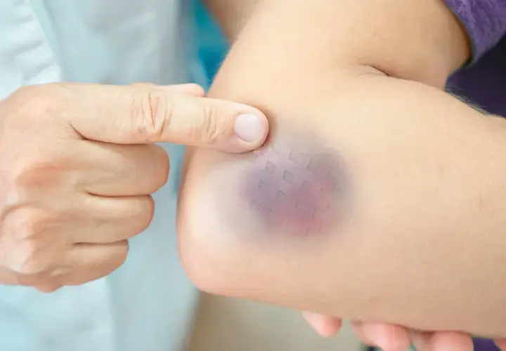Dito un braccio con un livido viola e un cerotto a quadretti, segno di un trauma braccio dopo caduta.