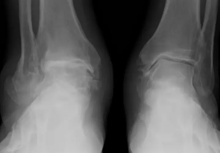 Radiografie delle caviglie mostrano segni di artrosi, con alterazioni ossee e riduzione dello spazio articolare.