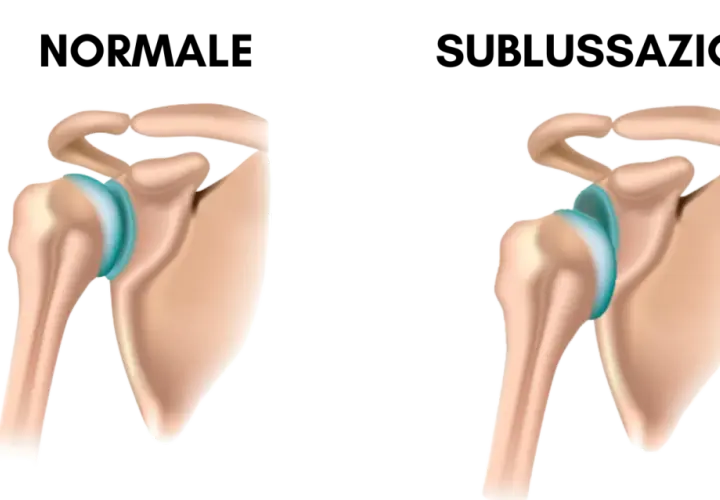 Spalla normale vs. sublussazione: quando il dolore spalla sinistra quando preoccuparsi? Illustrazione anatomica.