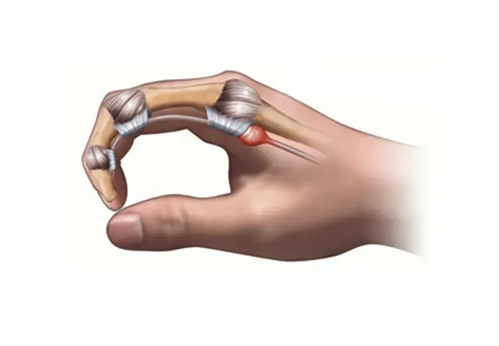 Dito cosa fare per il pollice a scatto: infiammazione del tendine e della guaina tendinea.