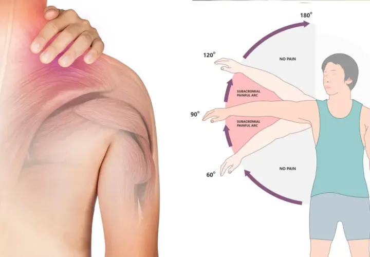 Illustrazione anatomica della spalla con dolore e diagramma che mostra gli esercizi per la spalla congelata, evidenziando l'arco doloroso.