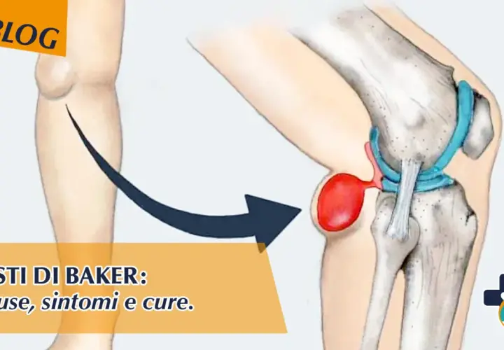 Illustrazione anatomica di una cisti di Baker nel ginocchio, con indicazioni su cause, sintomi e cure. I tempi di guarigione variano.