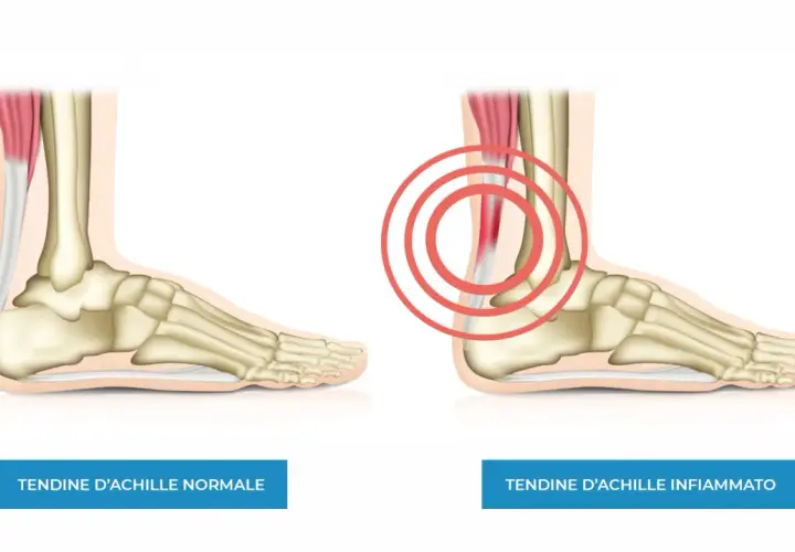 Confronto tra tendine d'Achille normale e infiammato. L'immagine mostra un piede con scheletro e muscolatura, evidenziando la differenza tra un tendine sano e uno irritato con cerchi rossi.