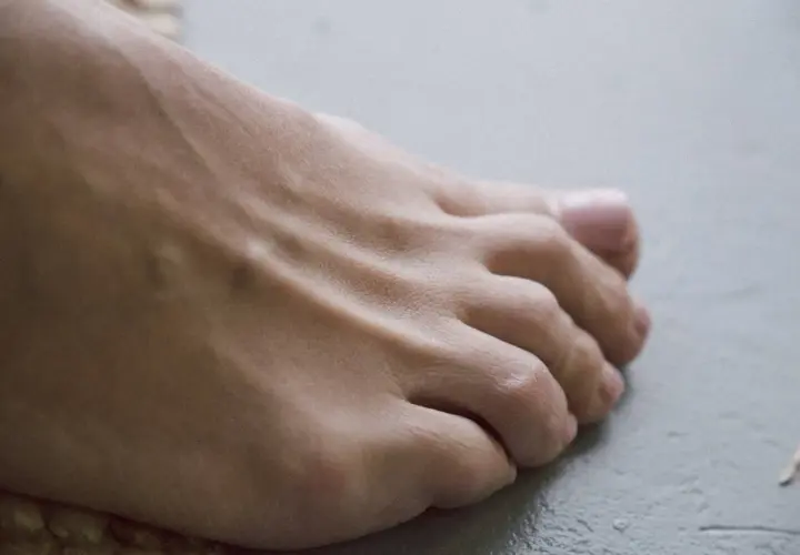 Piedi con gonfiore e arrossamento, possibili sintomi iniziali di artrite reumatoide.